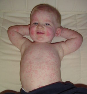 megalerythema infectiosum